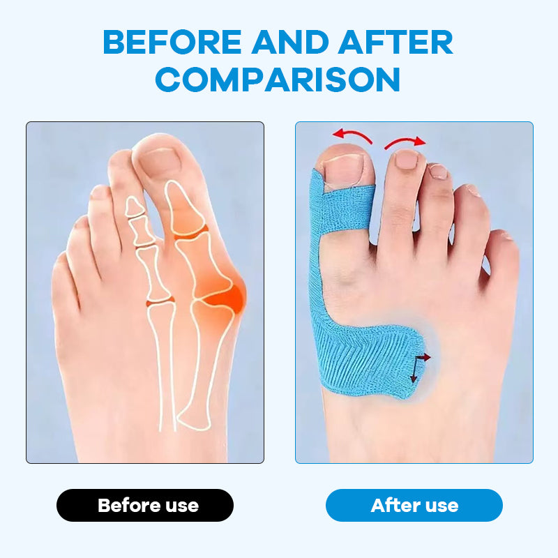 🔥Last Day - 49% Discount🔥 - Hallux Valgus Correction Kinesiology Patches